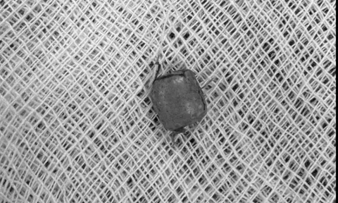 Bé 10 tuổi ù tai kéo dài, bác sĩ lấy ra thứ "đáng sợ" bên trong