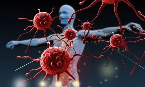 Ăn cơm có cảm giác nuốt vướng, người đàn ông sốc khi phát hiện 3 bệnh ung thư cùng lúc