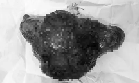 Cụ bà 72 tuổi đau âm ỉ nhiều ngày, bác sĩ sốc khi lấy ra thứ "đáng sợ" bên trong bụng