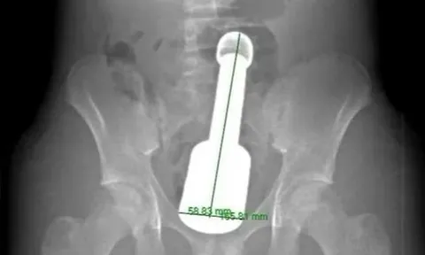 Nam thanh niên 15 tuổi nhập viện vì đau bụng dữ dội, bác sĩ sốc khi phát hiện thứ “đáng sợ” bên trong