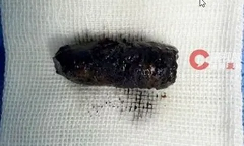 Mũi người đàn ông chảy dịch dai dẳng, bác sĩ phát hiện bí mật đáng sợ