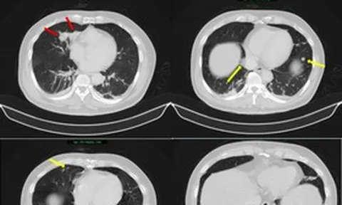 Người đàn ông 63 tuổi sốc nặng khi phát hiện mắc hai bệnh ung thư cùng lúc