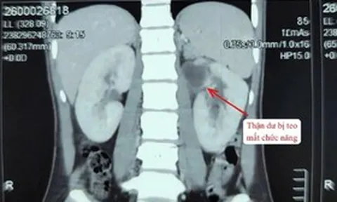 Kỳ lạ cô gái 22 tuổi có 3 quả thận