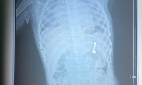 Đang chơi ở nhà, bé gần 2 tuổi nuốt phải thứ "đáng sợ"