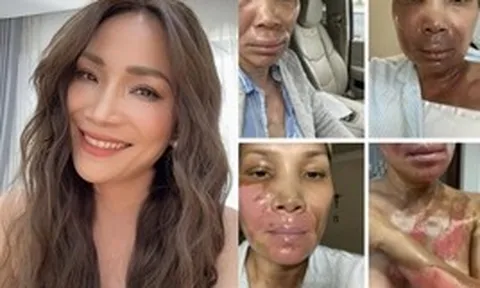 Xót xa nữ nghệ sĩ đình đám bị bỏng nghiêm trọng vì nổ nồi xông hơi: "Còn sống là hạnh phúc"