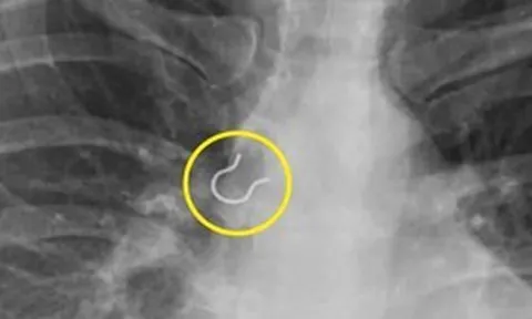 Người phụ nữ 25 tuổi ho dữ dội, bác sĩ sốc nặng khi phát hiện bí mật "đáng sợ"