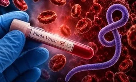 Bác sĩ cảnh báo triệu chứng của Ebola dễ bị bỏ qua