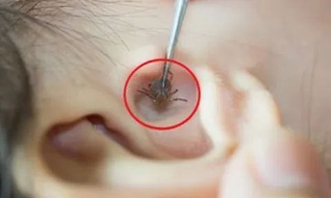 Bé 2 tuổi đau tai bất thường, bố mẹ "sốc" khi bác sĩ gắp ra thứ "đáng sợ" bên trong